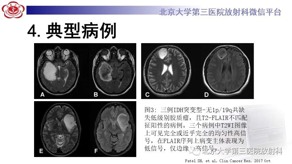影像PPT - 【PPT】低级别星形细胞瘤中的T2/Flair不匹配征-11