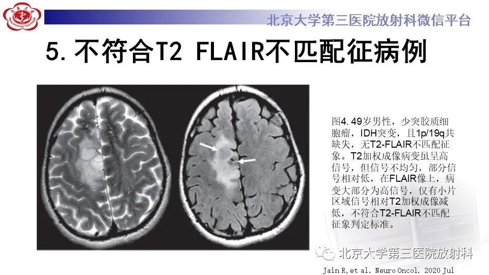 影像PPT - 【PPT】低级别星形细胞瘤中的T2/Flair不匹配征-12