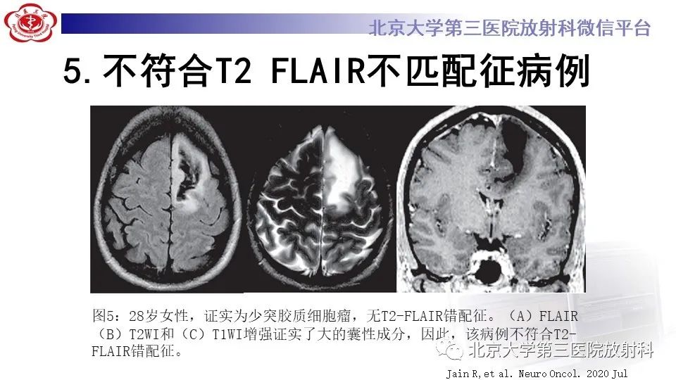 影像PPT - 【PPT】低级别星形细胞瘤中的T2/Flair不匹配征-13