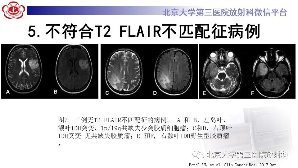 影像PPT - 【PPT】低级别星形细胞瘤中的T2/Flair不匹配征-15