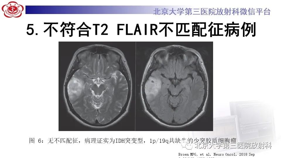 影像PPT - 【PPT】低级别星形细胞瘤中的T2/Flair不匹配征-14