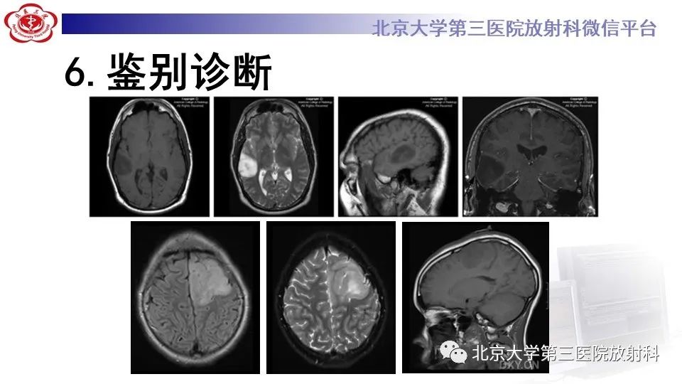 影像PPT - 【PPT】低级别星形细胞瘤中的T2/Flair不匹配征-18