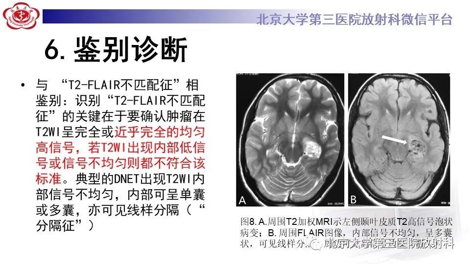 影像PPT - 【PPT】低级别星形细胞瘤中的T2/Flair不匹配征-19