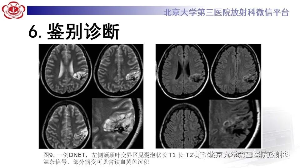 影像PPT - 【PPT】低级别星形细胞瘤中的T2/Flair不匹配征-20