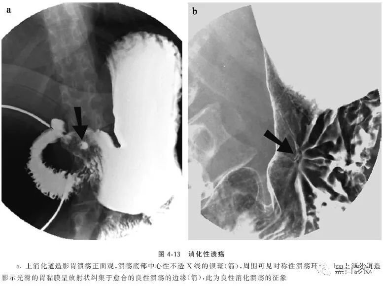 影像PPT - 肠道穿孔中的几个重要征象-1