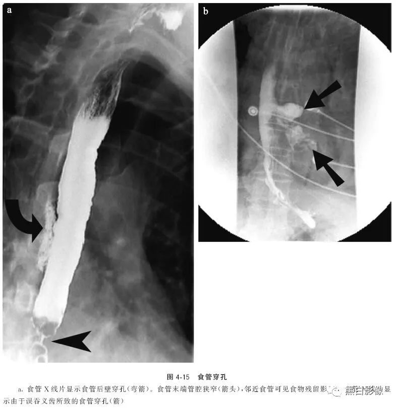 影像PPT - 肠道穿孔中的几个重要征象-3