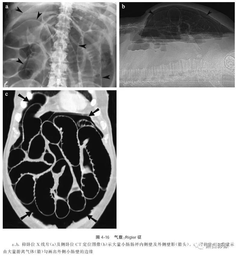影像PPT - 肠道穿孔中的几个重要征象-4