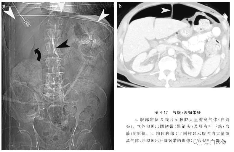影像PPT - 肠道穿孔中的几个重要征象-5
