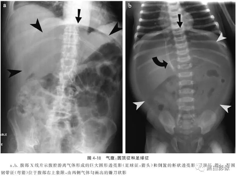 影像PPT - 肠道穿孔中的几个重要征象-6