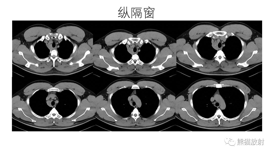 影像PPT - 【PPT】纵隔血管瘤 VS Castleman病-10