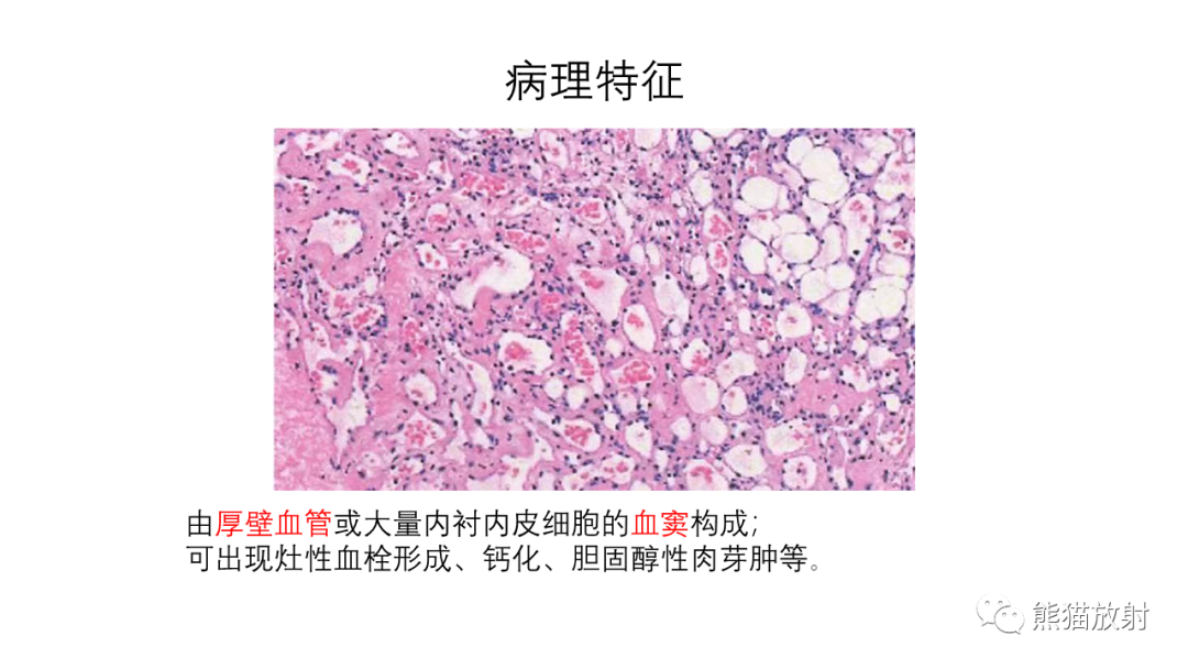 影像PPT - 【PPT】纵隔血管瘤 VS Castleman病-17