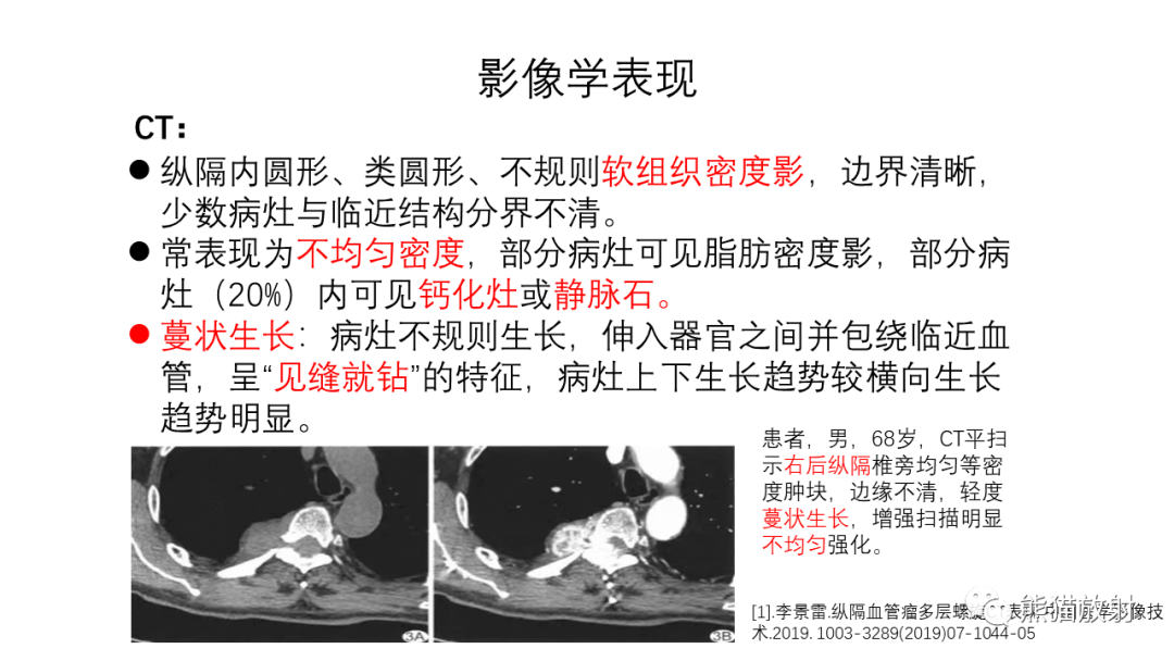 影像PPT - 【PPT】纵隔血管瘤 VS Castleman病-18