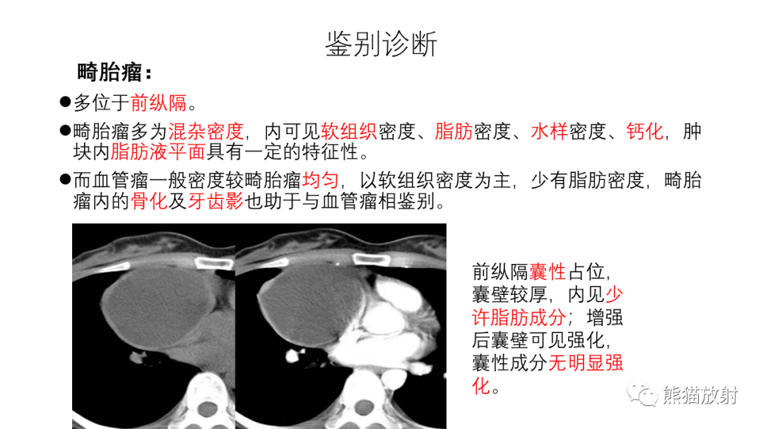 影像PPT - 【PPT】纵隔血管瘤 VS Castleman病-34