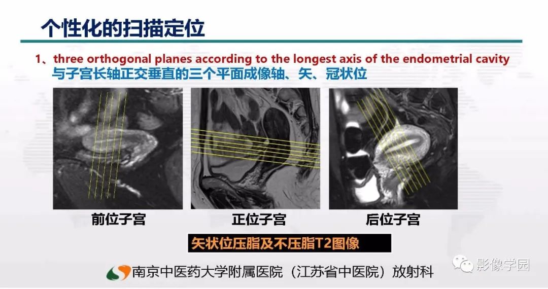 影像PPT - 【PPT】子宫内膜癌MR诊断与鉴别-4
