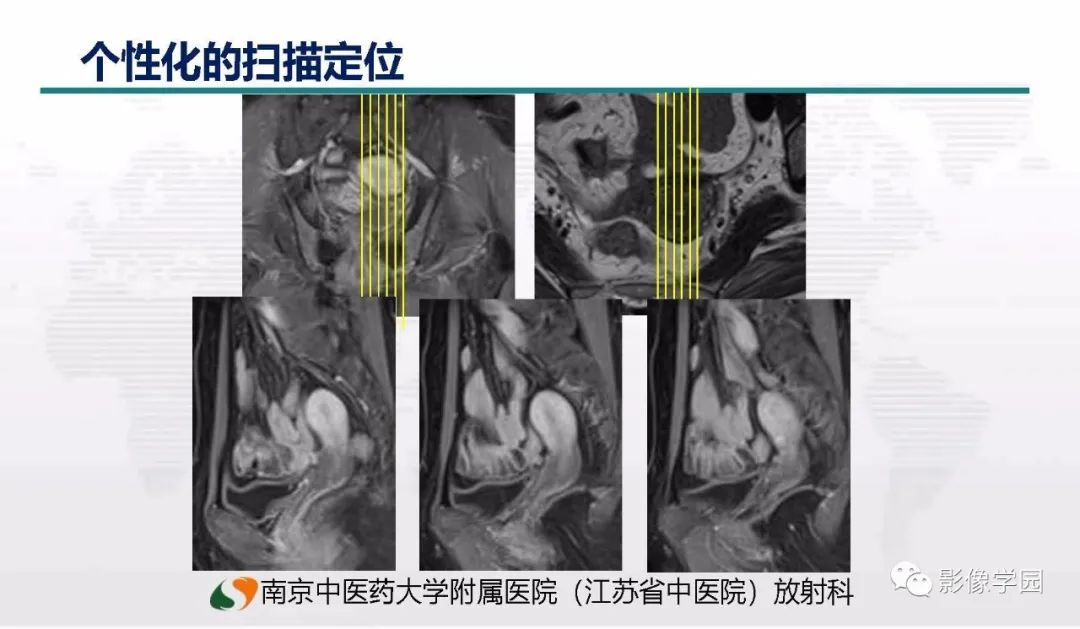 影像PPT - 【PPT】子宫内膜癌MR诊断与鉴别-5