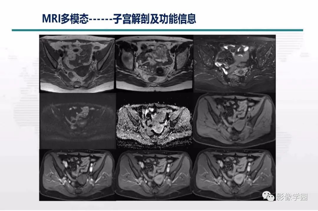 影像PPT - 【PPT】子宫内膜癌MR诊断与鉴别-6