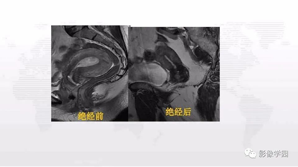 影像PPT - 【PPT】子宫内膜癌MR诊断与鉴别-10