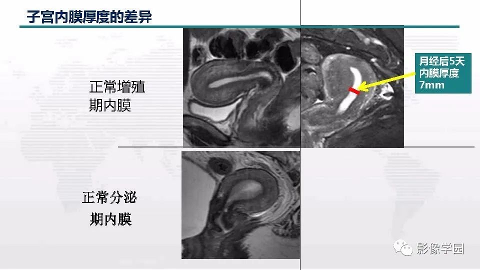 影像PPT - 【PPT】子宫内膜癌MR诊断与鉴别-11