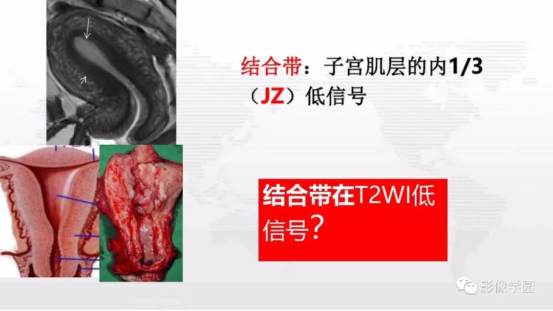 影像PPT - 【PPT】子宫内膜癌MR诊断与鉴别-16
