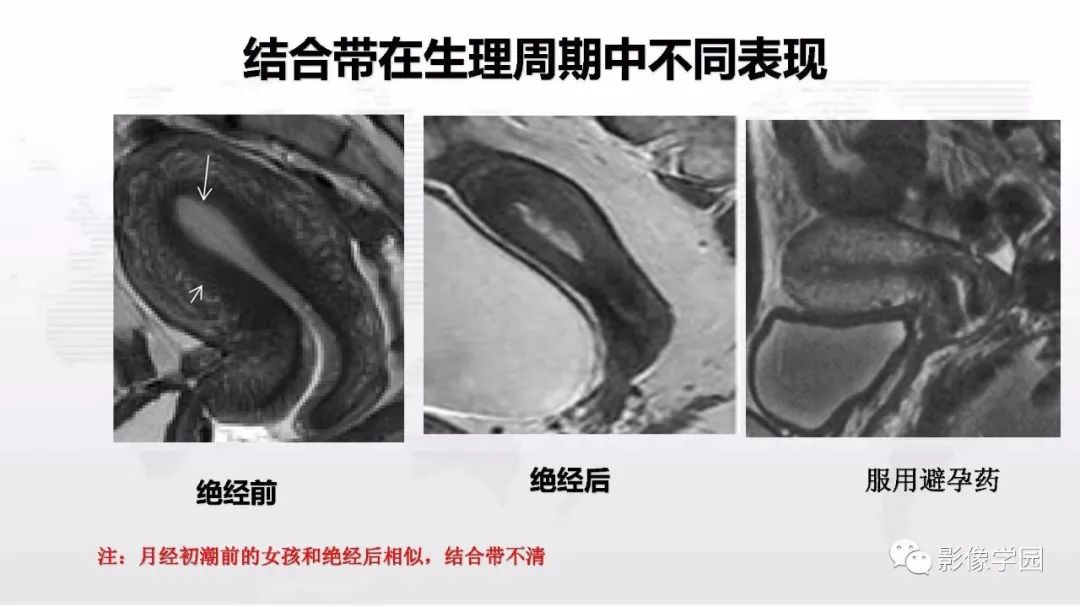 影像PPT - 【PPT】子宫内膜癌MR诊断与鉴别-19