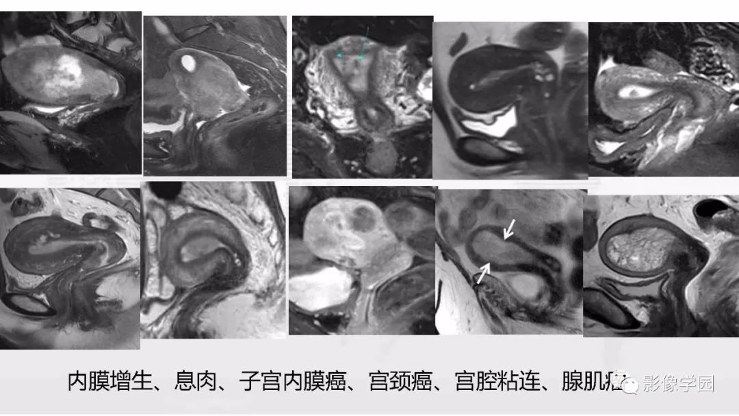 影像PPT - 【PPT】子宫内膜癌MR诊断与鉴别-21