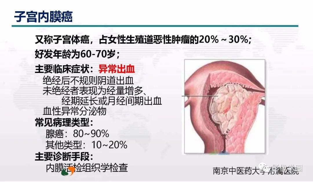 影像PPT - 【PPT】子宫内膜癌MR诊断与鉴别-23