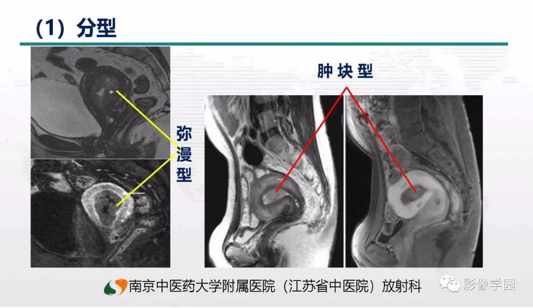 影像PPT - 【PPT】子宫内膜癌MR诊断与鉴别-24
