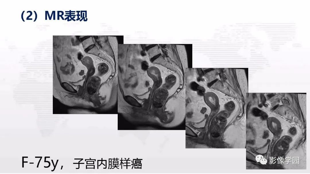 影像PPT - 【PPT】子宫内膜癌MR诊断与鉴别-25