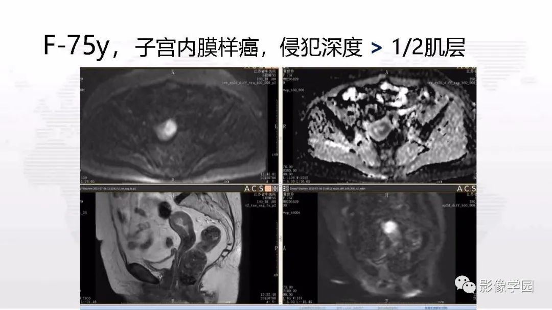 影像PPT - 【PPT】子宫内膜癌MR诊断与鉴别-27
