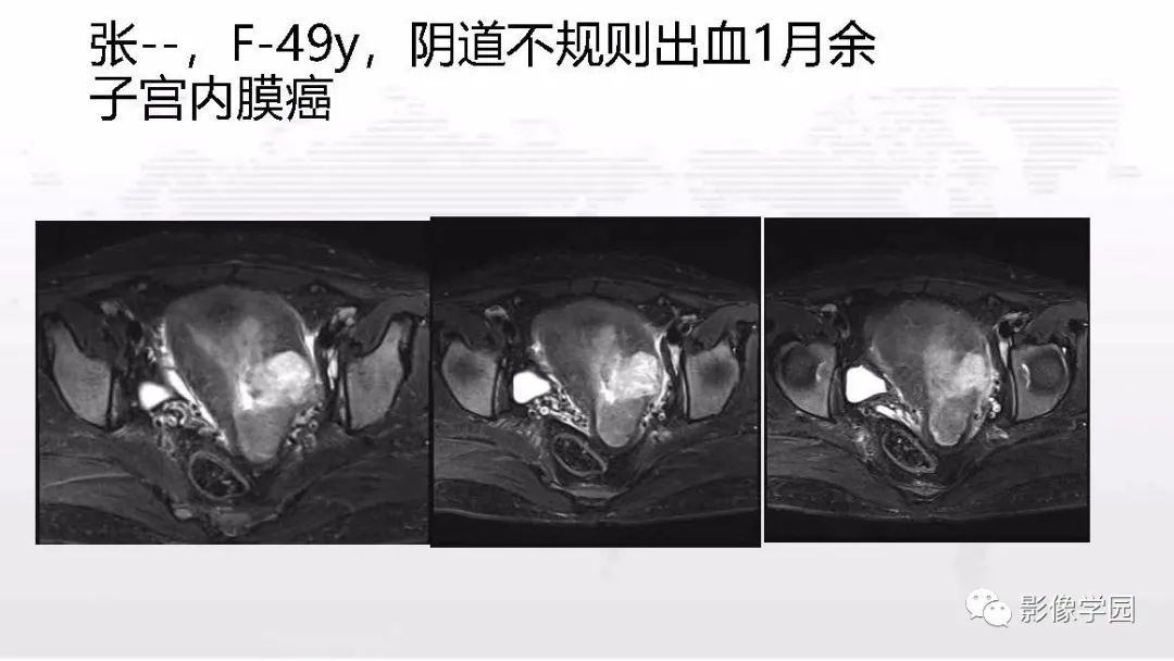 影像PPT - 【PPT】子宫内膜癌MR诊断与鉴别-30