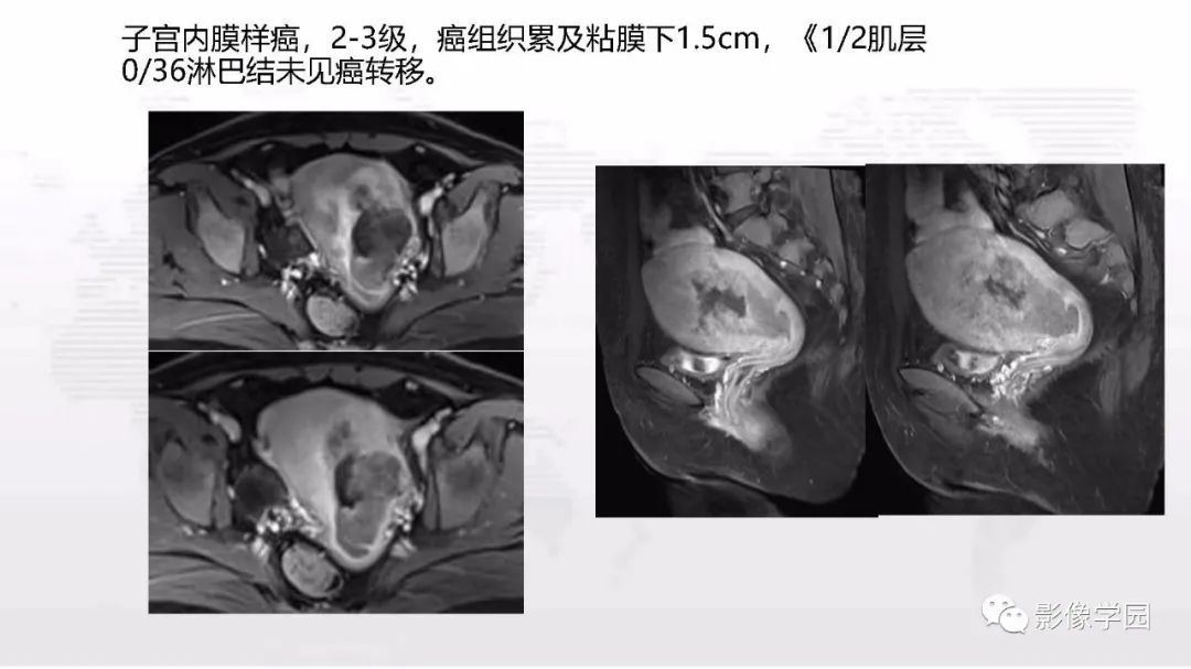 影像PPT - 【PPT】子宫内膜癌MR诊断与鉴别-35