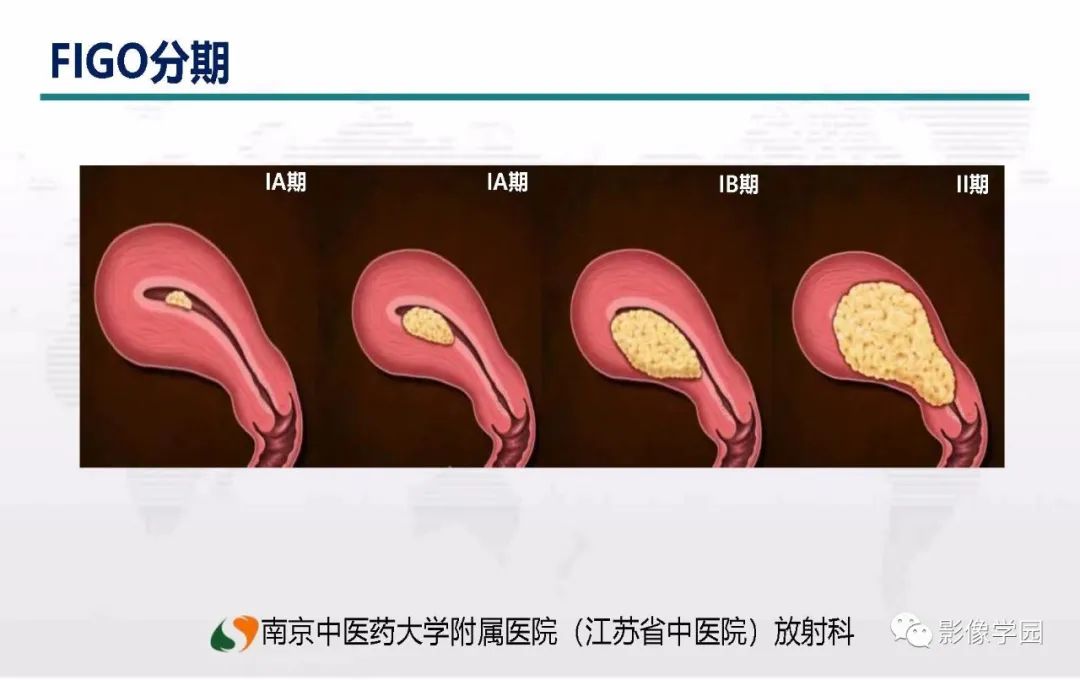 影像PPT - 【PPT】子宫内膜癌MR诊断与鉴别-37