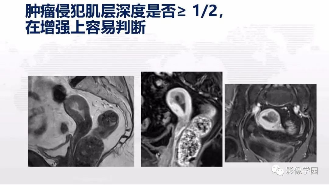 影像PPT - 【PPT】子宫内膜癌MR诊断与鉴别-38