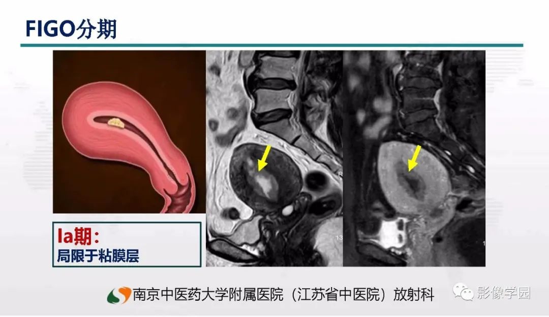影像PPT - 【PPT】子宫内膜癌MR诊断与鉴别-39