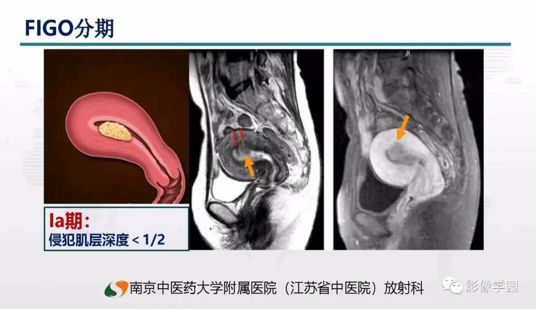 影像PPT - 【PPT】子宫内膜癌MR诊断与鉴别-40