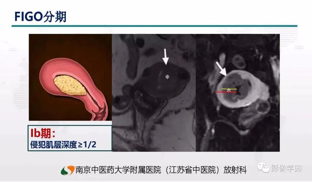 影像PPT - 【PPT】子宫内膜癌MR诊断与鉴别-41