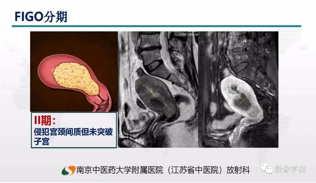 影像PPT - 【PPT】子宫内膜癌MR诊断与鉴别-42