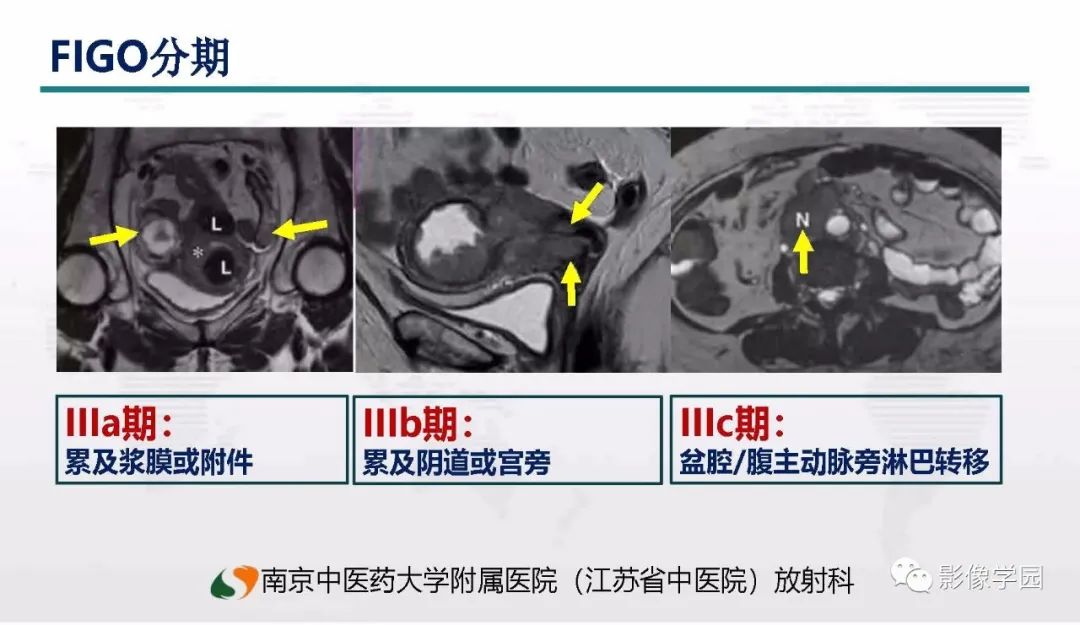 影像PPT - 【PPT】子宫内膜癌MR诊断与鉴别-43