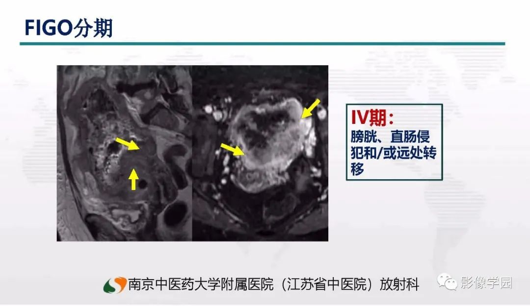 影像PPT - 【PPT】子宫内膜癌MR诊断与鉴别-44