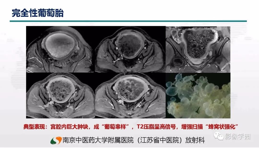 影像PPT - 【PPT】子宫内膜癌MR诊断与鉴别-47