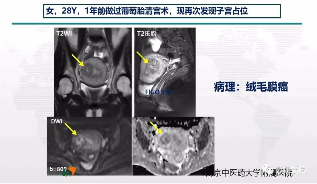 影像PPT - 【PPT】子宫内膜癌MR诊断与鉴别-48