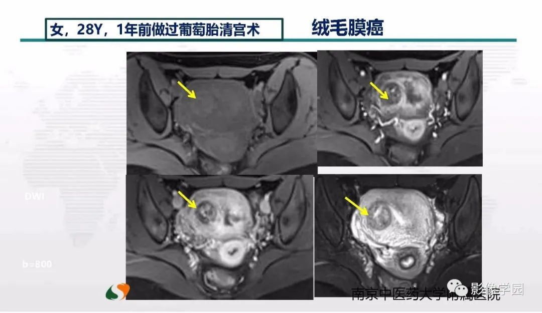 影像PPT - 【PPT】子宫内膜癌MR诊断与鉴别-49