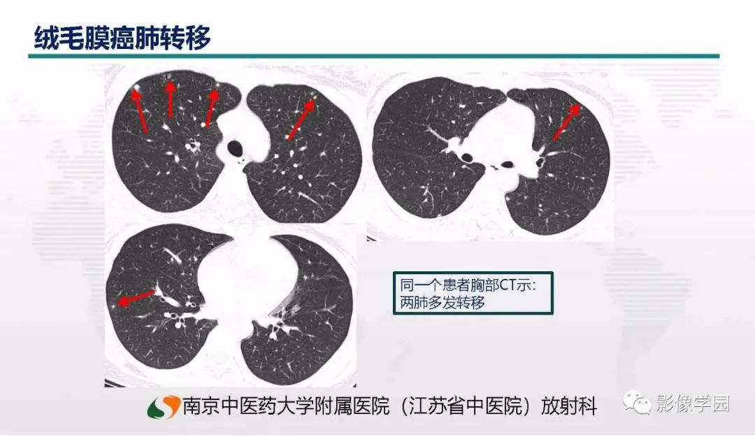 影像PPT - 【PPT】子宫内膜癌MR诊断与鉴别-50