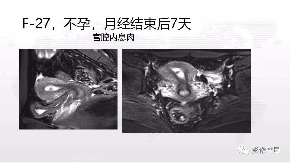 影像PPT - 【PPT】子宫内膜癌MR诊断与鉴别-52