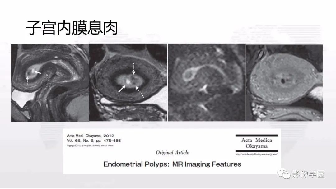 影像PPT - 【PPT】子宫内膜癌MR诊断与鉴别-53