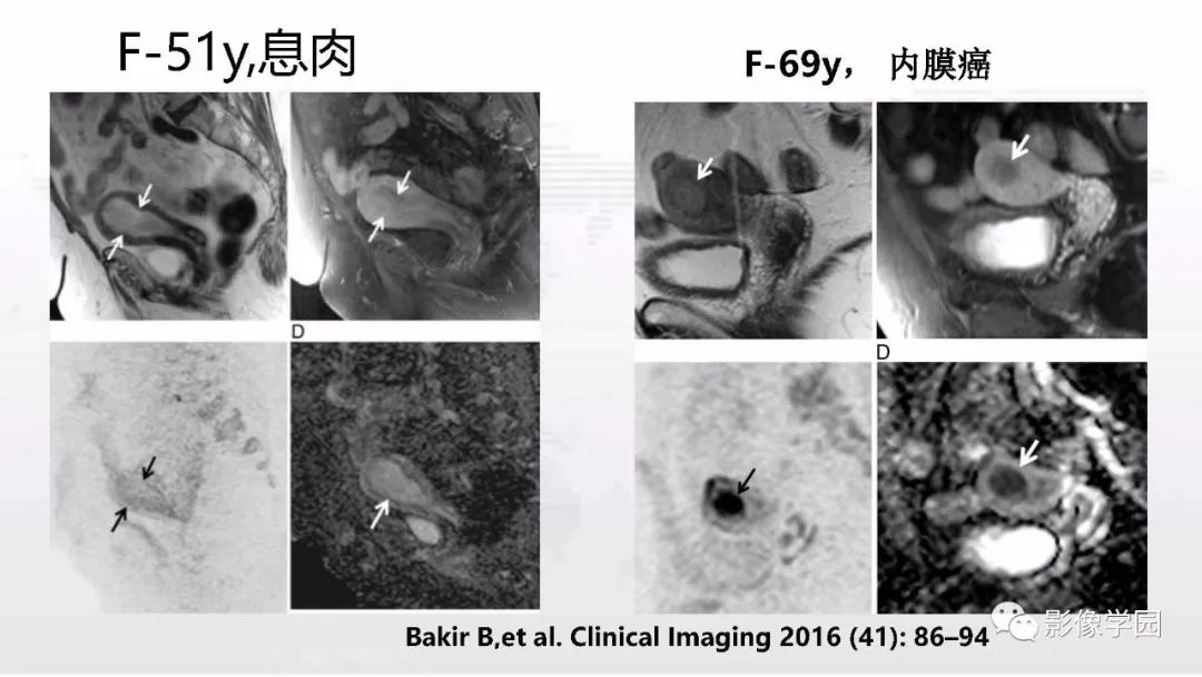 影像PPT - 【PPT】子宫内膜癌MR诊断与鉴别-54