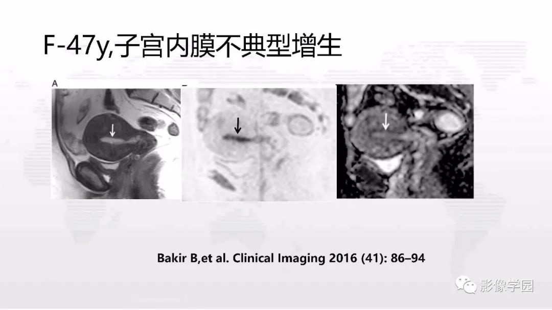 影像PPT - 【PPT】子宫内膜癌MR诊断与鉴别-56
