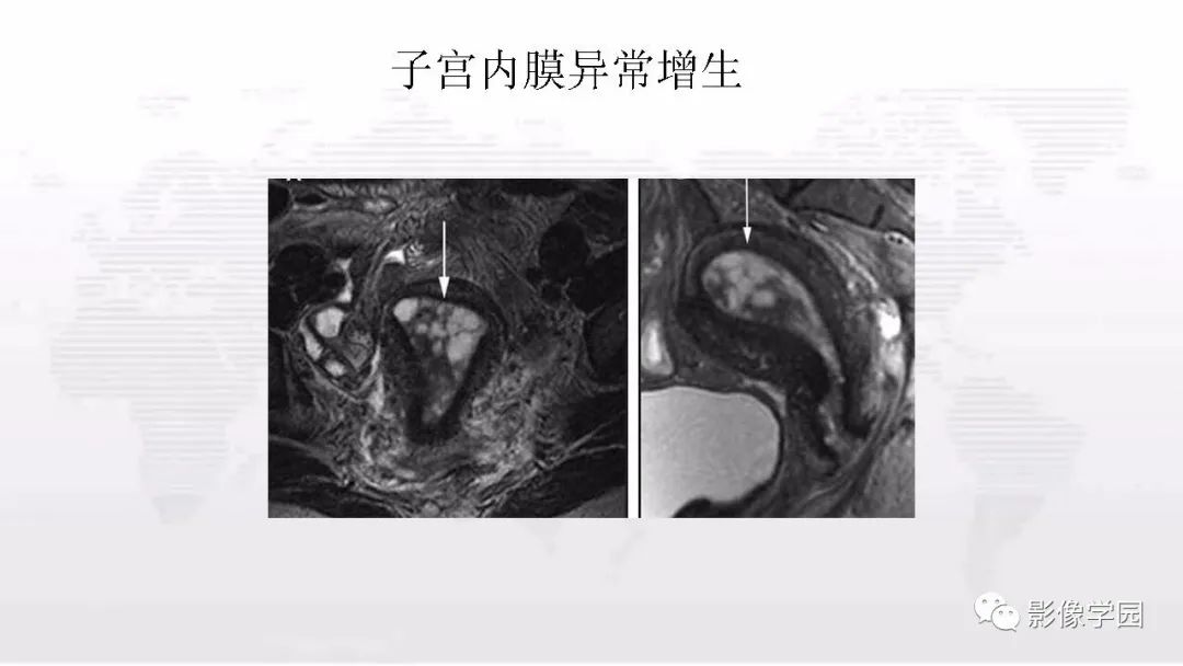 影像PPT - 【PPT】子宫内膜癌MR诊断与鉴别-57