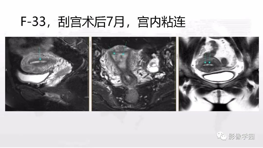 影像PPT - 【PPT】子宫内膜癌MR诊断与鉴别-60