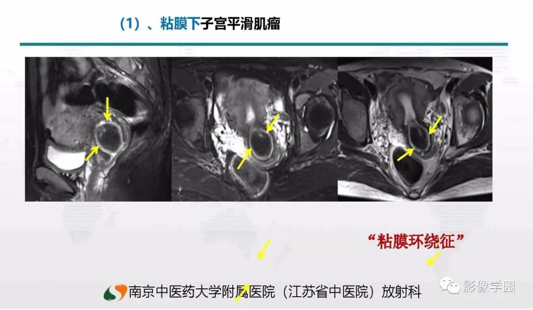 影像PPT - 【PPT】子宫内膜癌MR诊断与鉴别-66